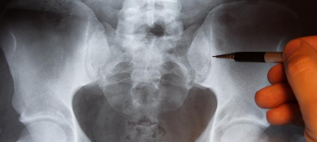 What to Expect during Hip Fracture Recovery